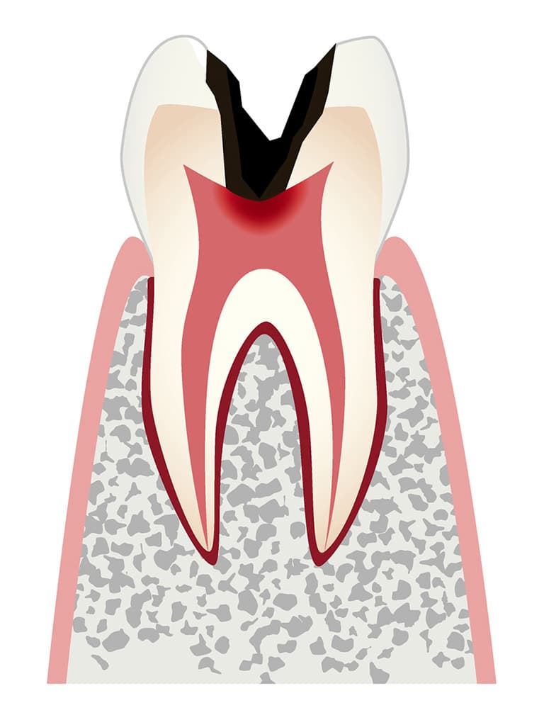 神経まで進行した虫歯のイラスト