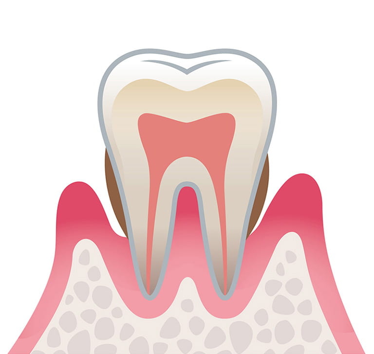 歯周病中等度のイラスト